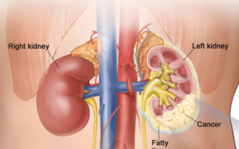 Things We Should Know About Kidney Cance